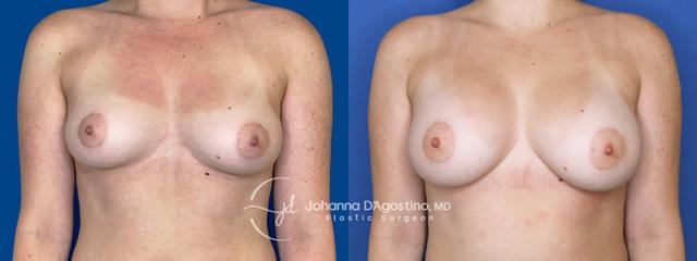 Breast Augmentation result at 5th Avenue Plastic Surgery in Delray Beach, FL