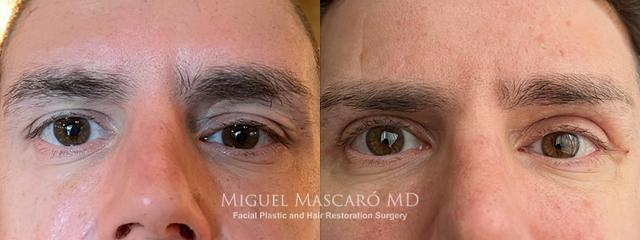 Blepharoplasty result at 5th Avenue Plastic Surgery in Delray Beach, FL