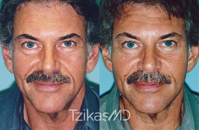 Fat Transfer result at 5th Avenue Plastic Surgery in Delray Beach, FL