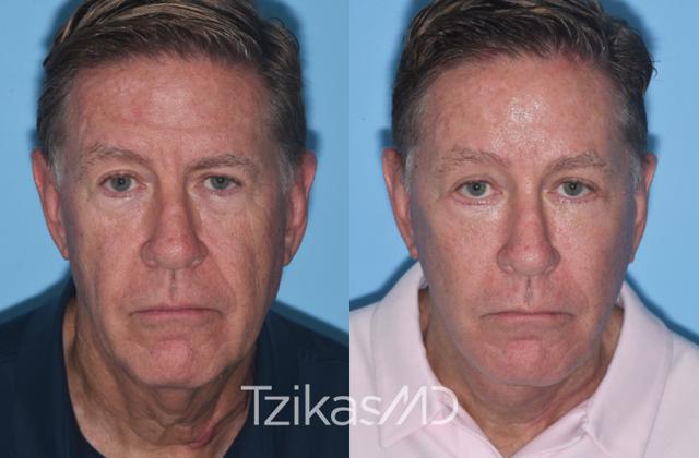 Brow Lift result at 5th Avenue Plastic Surgery in Delray Beach, FL