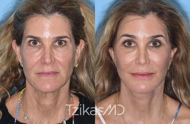 Brow Lift result at 5th Avenue Plastic Surgery in Delray Beach, FL