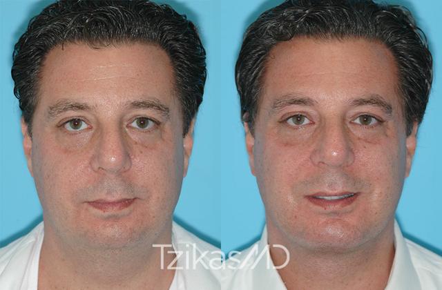 Chin Implant result at 5th Avenue Plastic Surgery in Delray Beach, FL