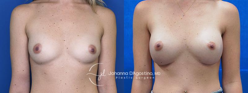 5th Avenue Plastic Surgery breast augmentation result — Delray Beach, FL