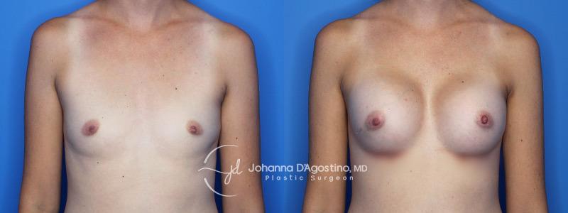 5th Avenue Plastic Surgery breast augmentation result — Delray Beach, FL