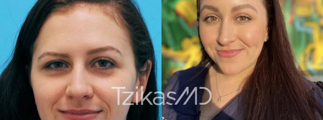 Brow Lift result at 5th Avenue Plastic Surgery in Delray Beach, FL