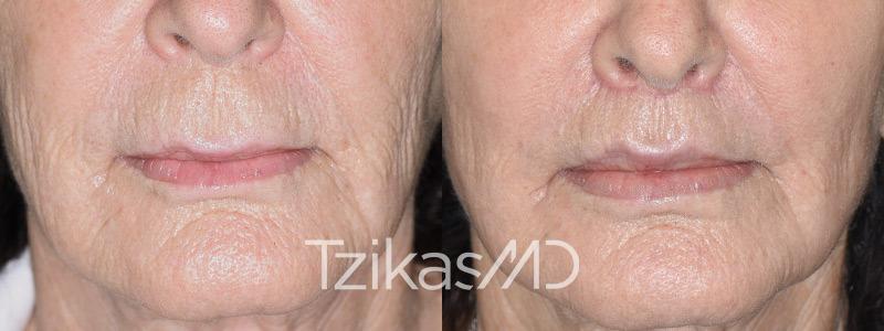 5th Avenue Plastic Surgery lip lift result — Delray Beach, FL