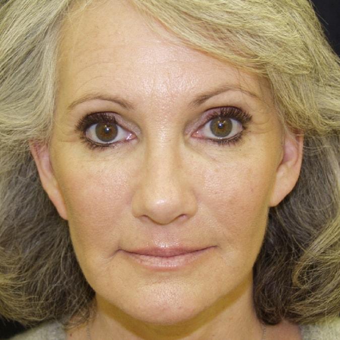 Leslie Stevens, MD brow lift after — Beverly Hills, CA