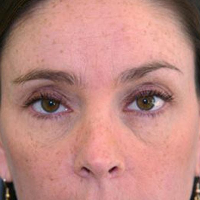 Leslie Stevens, MD brow lift after — Beverly Hills, CA