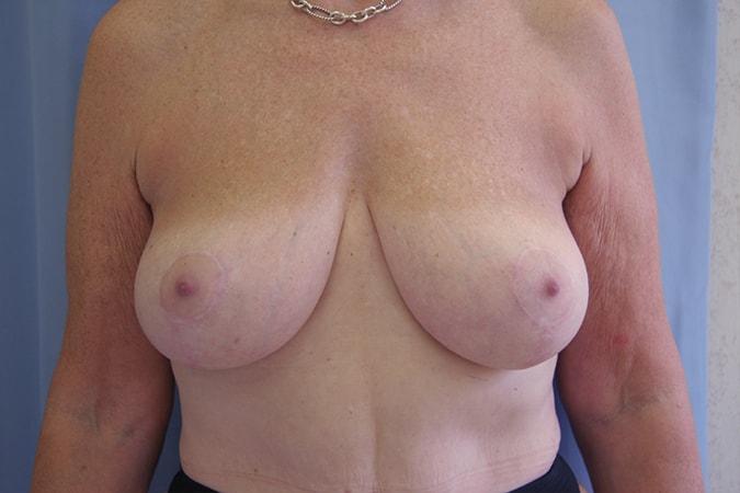 Leslie Stevens, MD breast reduction after — Beverly Hills, CA