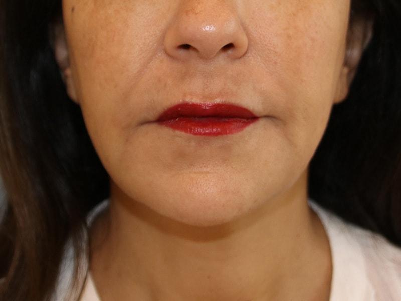 Leslie Stevens, MD lip filler after — Beverly Hills, CA