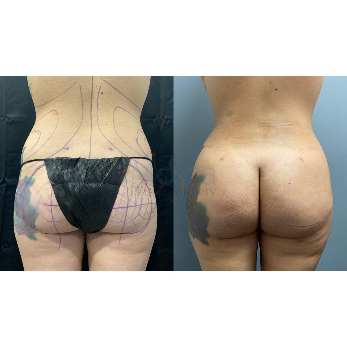 Mosca Plastic Surgery bbl result — Delray Beach, FL