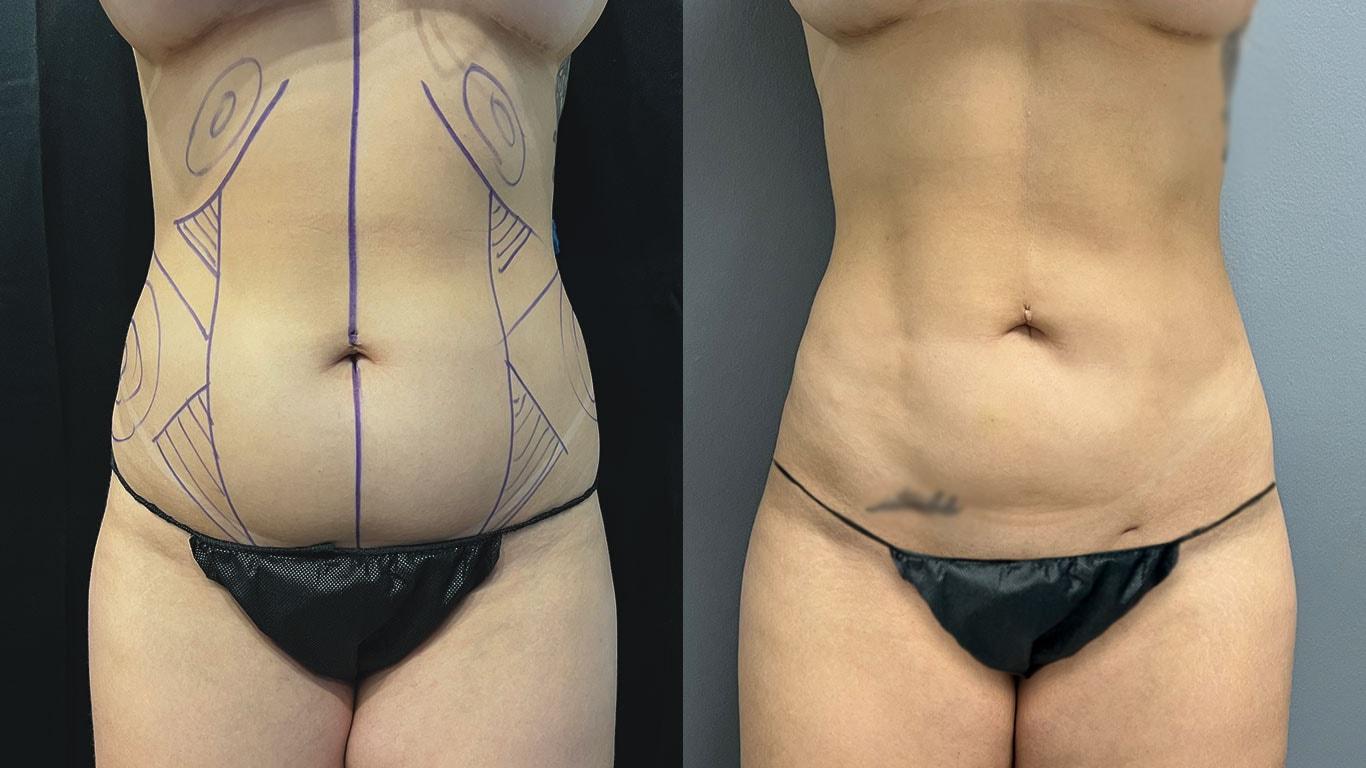Mosca Plastic Surgery liposuction result — Delray Beach, FL