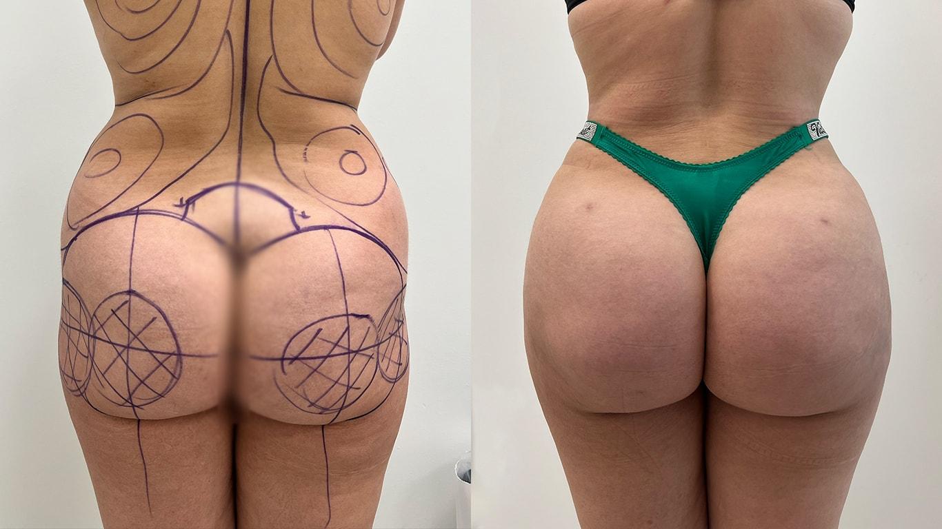 Mosca Plastic Surgery bbl result — Delray Beach, FL