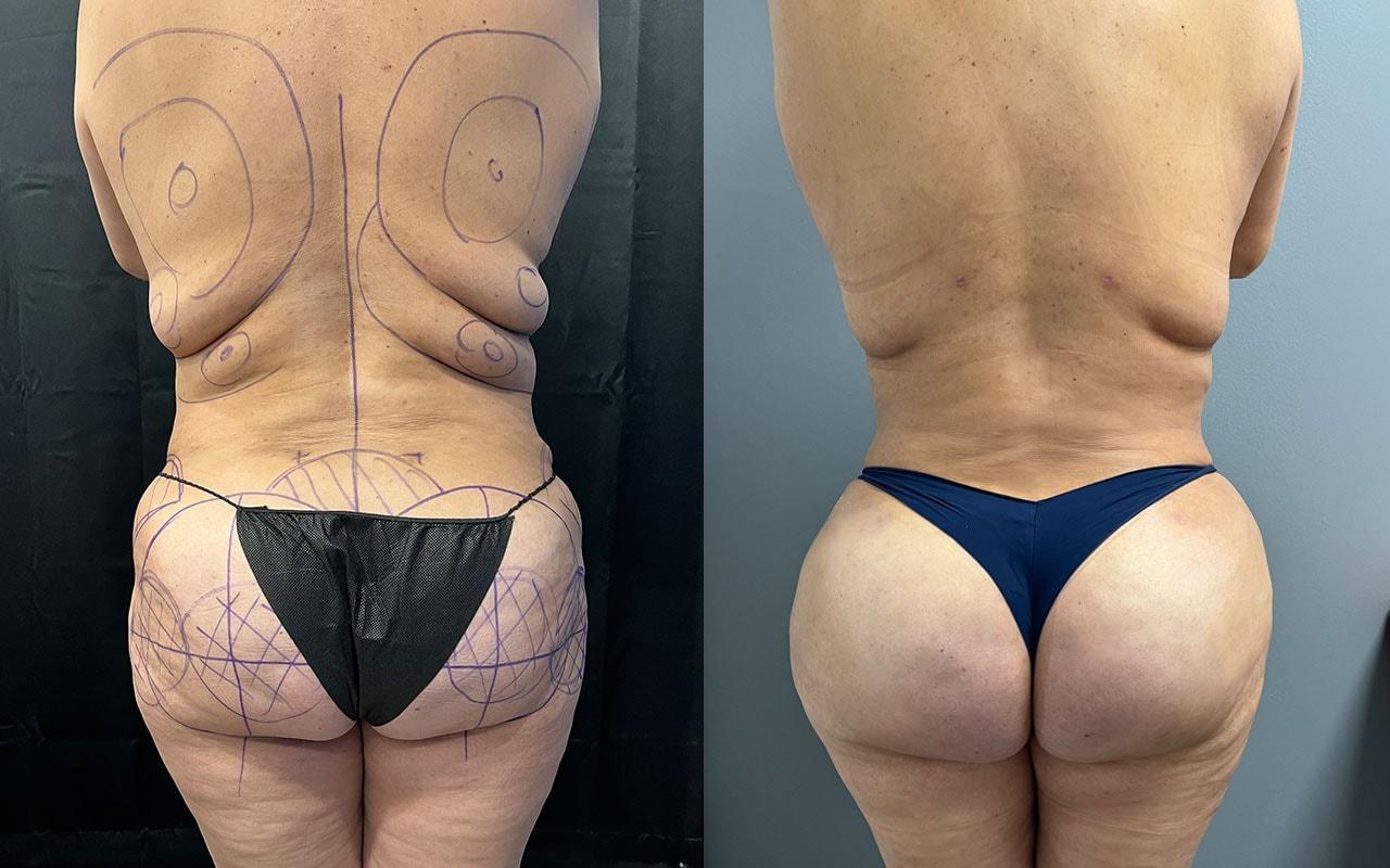 Mosca Plastic Surgery bbl result — Delray Beach, FL