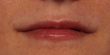 The Breslow Center for Plastic Surgery lip filler after — Paramus, NJ