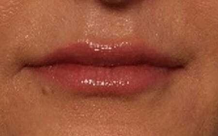 The Breslow Center for Plastic Surgery lip filler after — Paramus, NJ