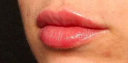 The Breslow Center for Plastic Surgery lip filler after — Paramus, NJ
