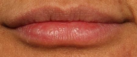 The Breslow Center for Plastic Surgery lip filler after — Paramus, NJ