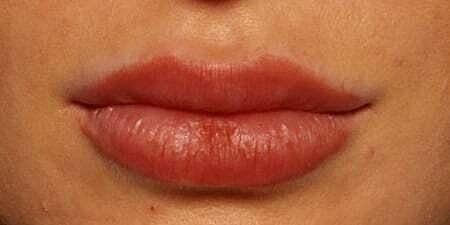 The Breslow Center for Plastic Surgery lip filler after — Paramus, NJ