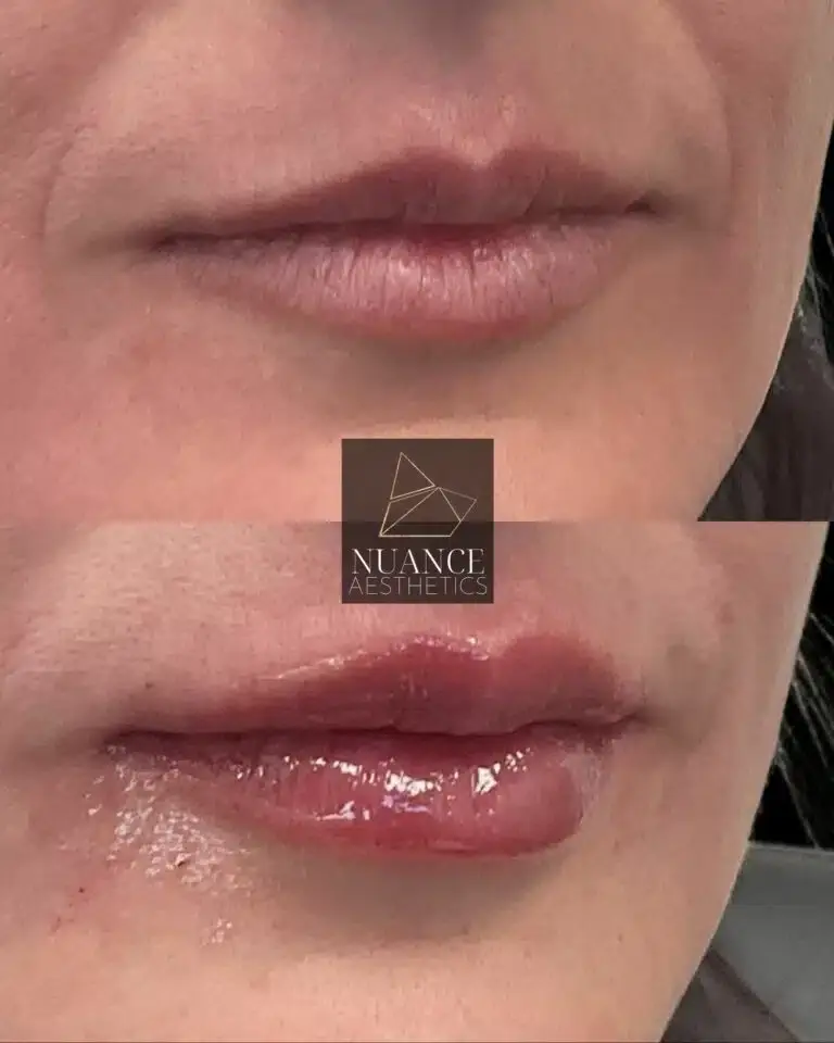 Nuance Aesthetics result — Salt Lake City, UT
