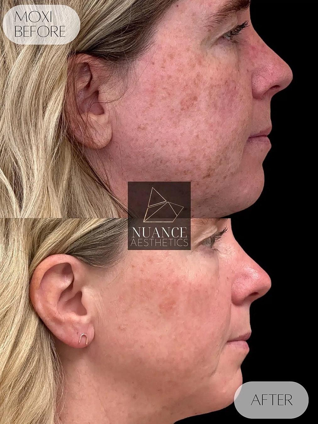 Nuance Aesthetics laser treatment result — Salt Lake City, UT
