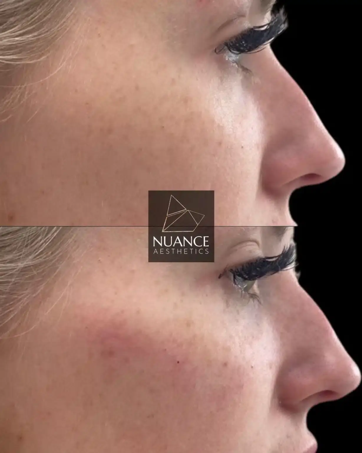 Nuance Aesthetics result — Salt Lake City, UT