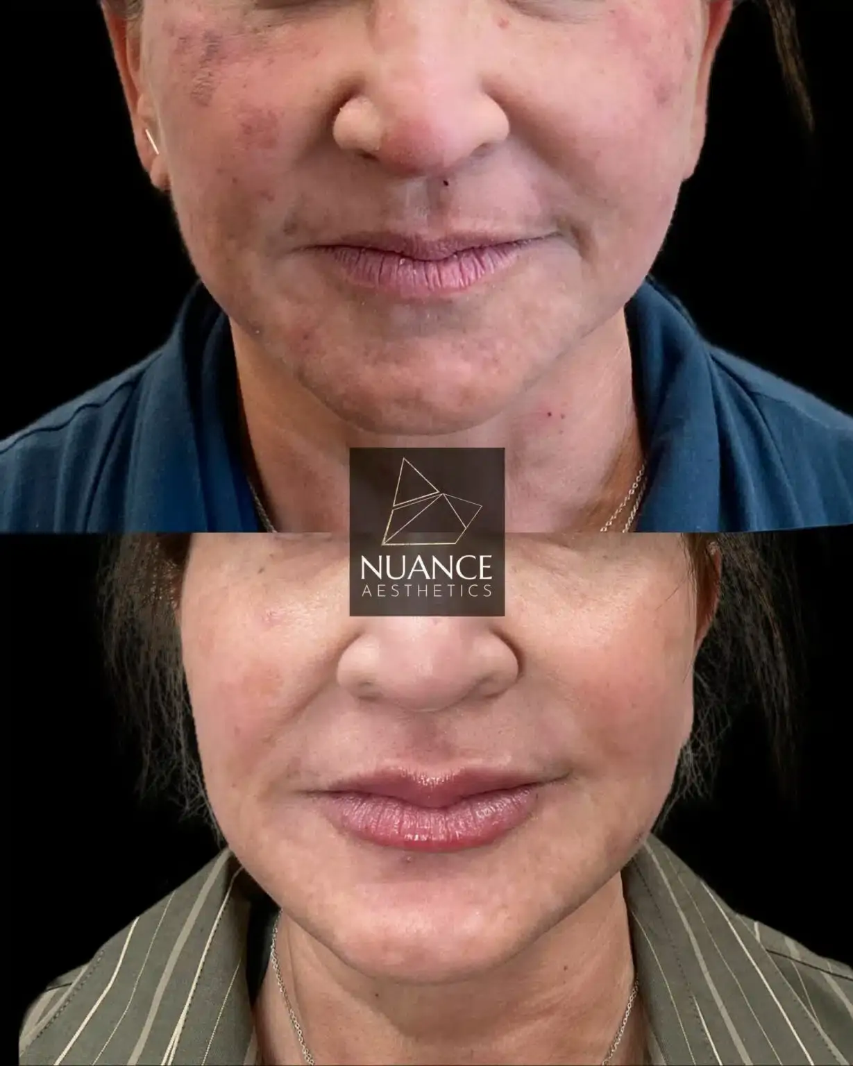 Nuance Aesthetics result — Salt Lake City, UT