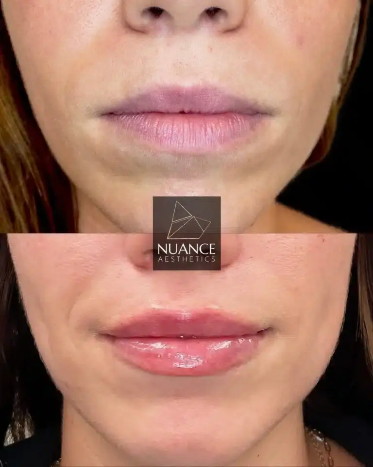 Nuance Aesthetics result — Salt Lake City, UT
