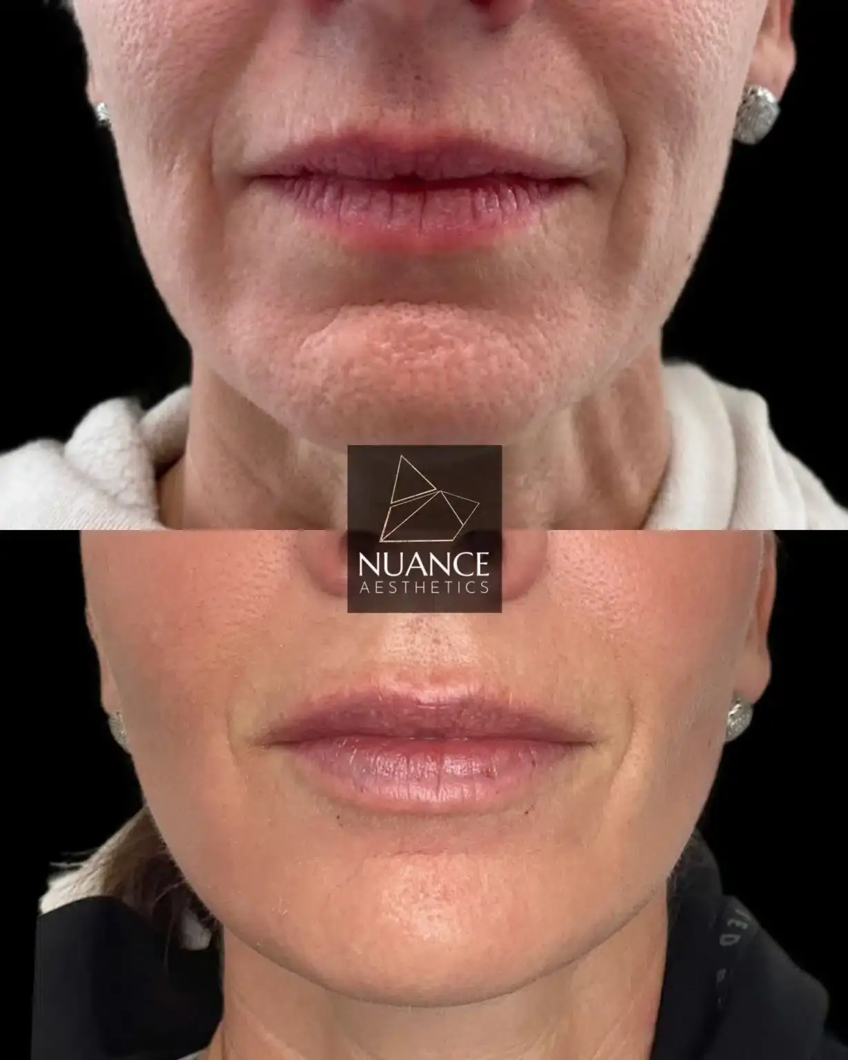 Nuance Aesthetics lip filler result — Salt Lake City, UT