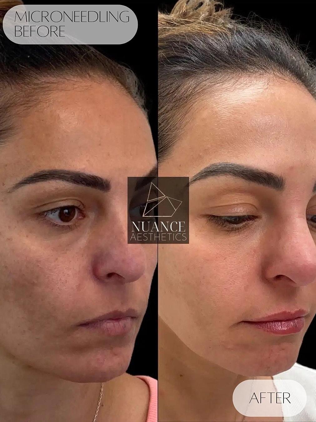 Nuance Aesthetics microneedling result — Salt Lake City, UT