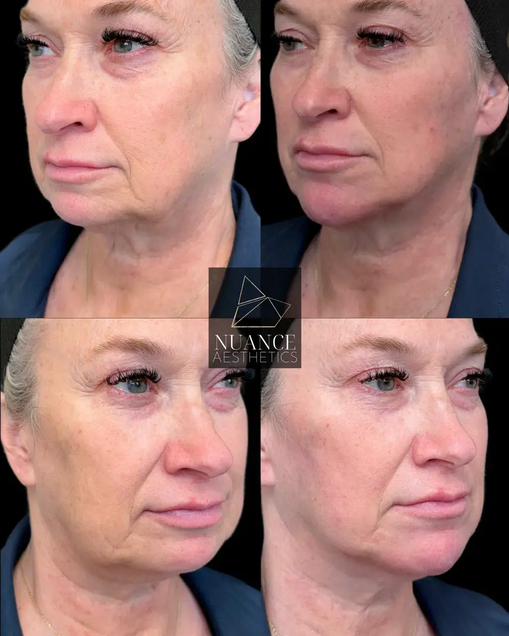 Nuance Aesthetics cheek filler result — Salt Lake City, UT