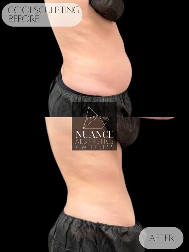 CoolSculpting result at Nuance Aesthetics in Salt Lake City, UT