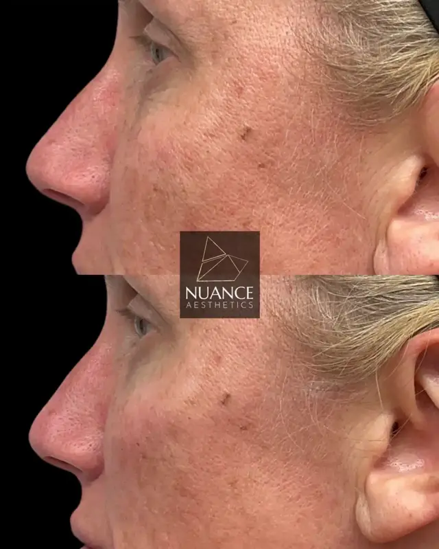 Dermal Fillers result at Nuance Aesthetics in Salt Lake City, UT
