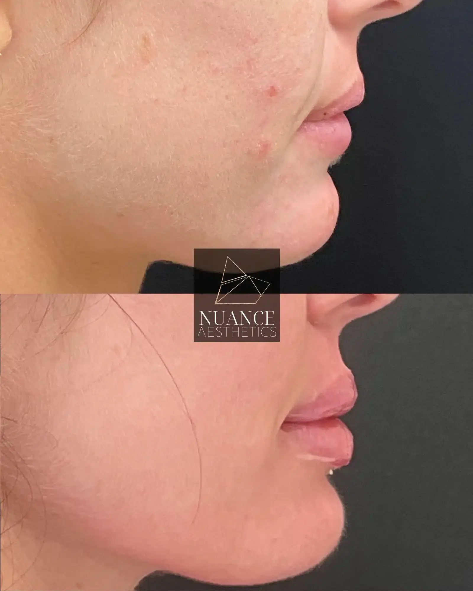 Nuance Aesthetics lip filler result — Salt Lake City, UT