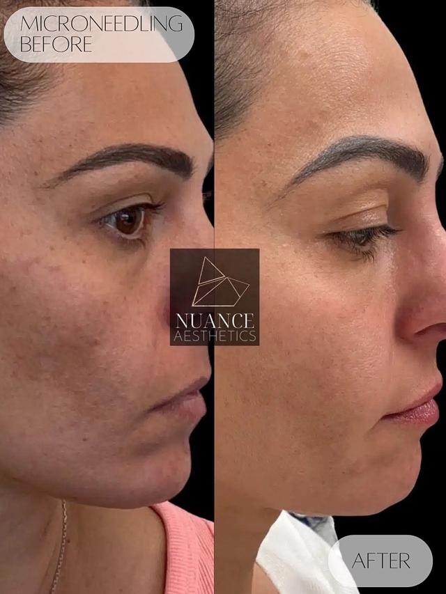 Microneedling result at Nuance Aesthetics in Salt Lake City, UT