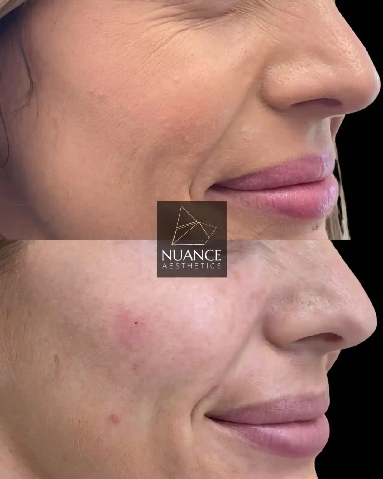 Nuance Aesthetics cheek filler result — Salt Lake City, UT