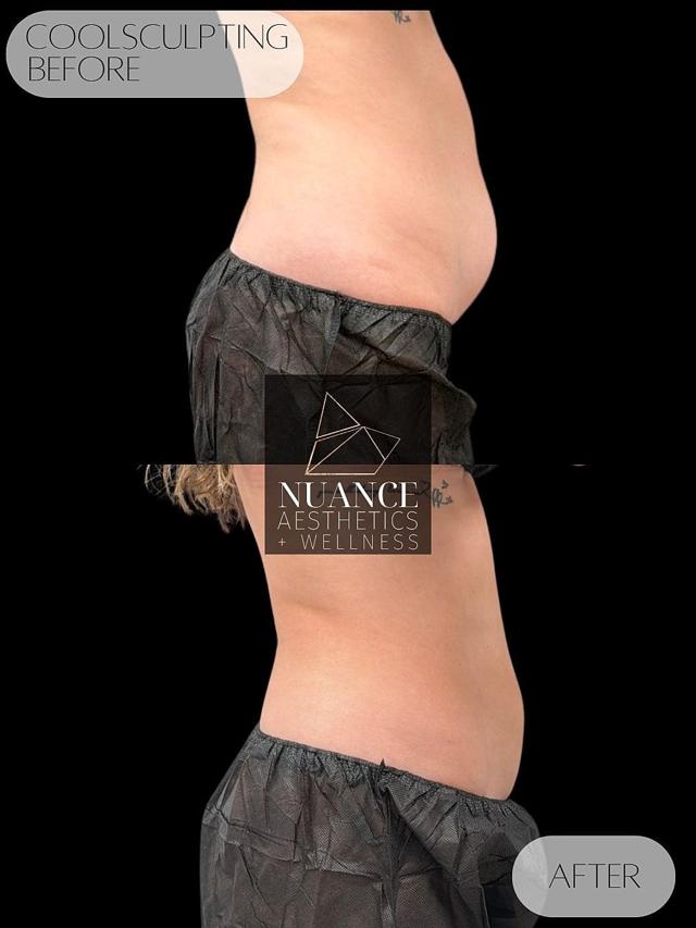 CoolSculpting result at Nuance Aesthetics in Salt Lake City, UT