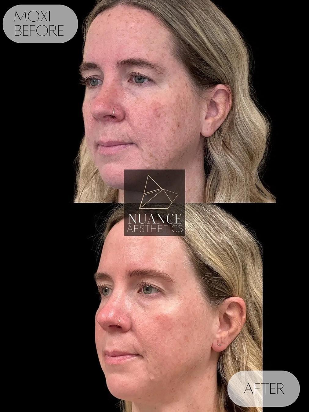 Nuance Aesthetics laser treatment result — Salt Lake City, UT