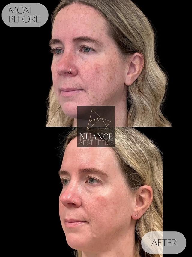Morpheus8 result at Nuance Aesthetics in Salt Lake City, UT