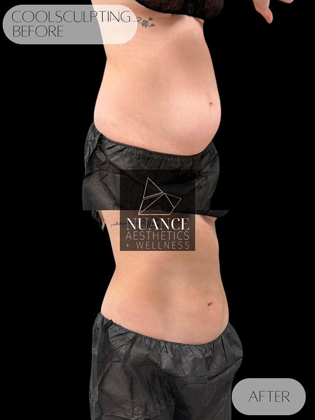 CoolSculpting result at Nuance Aesthetics in Salt Lake City, UT