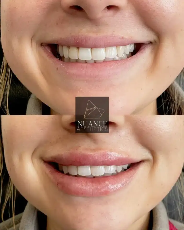 Nuance Aesthetics lip filler result — Salt Lake City, UT
