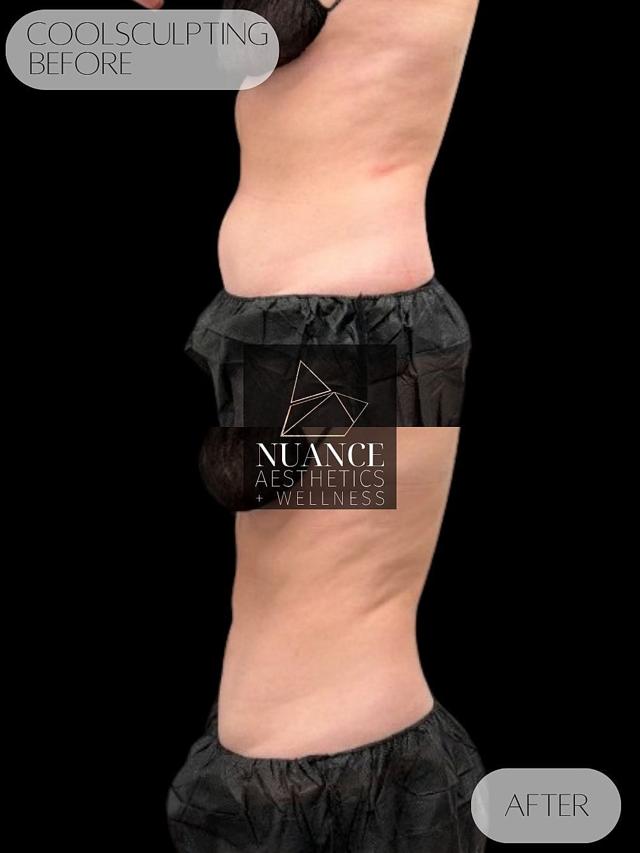 CoolSculpting result at Nuance Aesthetics in Salt Lake City, UT