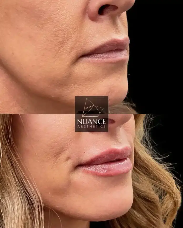 Nuance Aesthetics lip filler result — Salt Lake City, UT