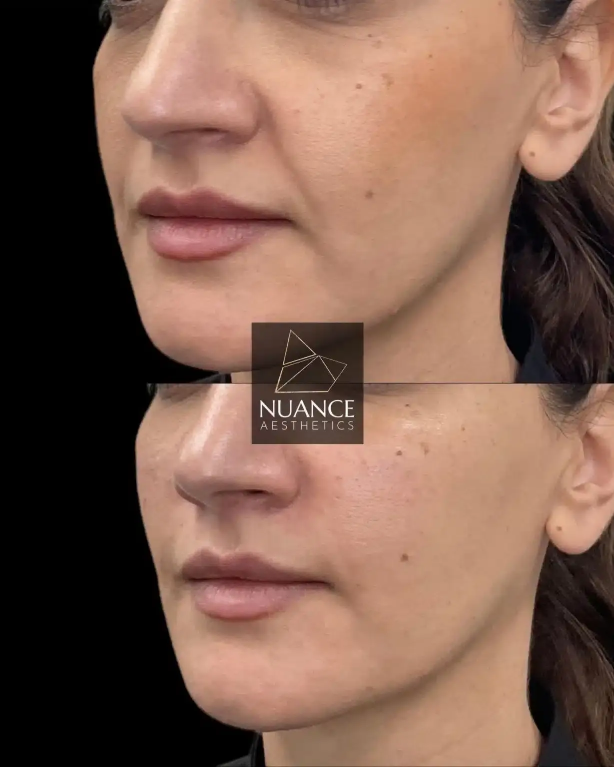 Nuance Aesthetics cheek filler result — Salt Lake City, UT
