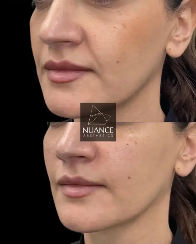 Juvederm result at Nuance Aesthetics in Salt Lake City, UT