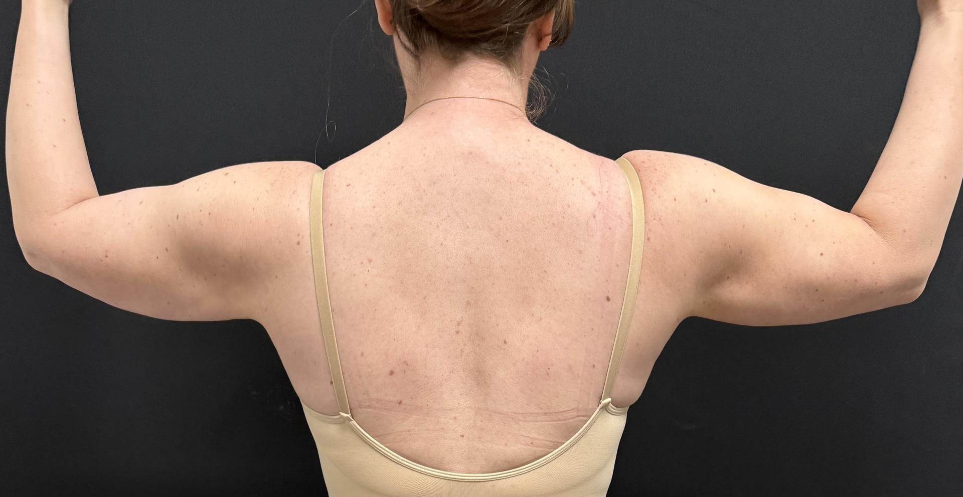 Norcal Liposculpture (Jack D. Friedlander, MD) liposuction after — Roseville, CA
