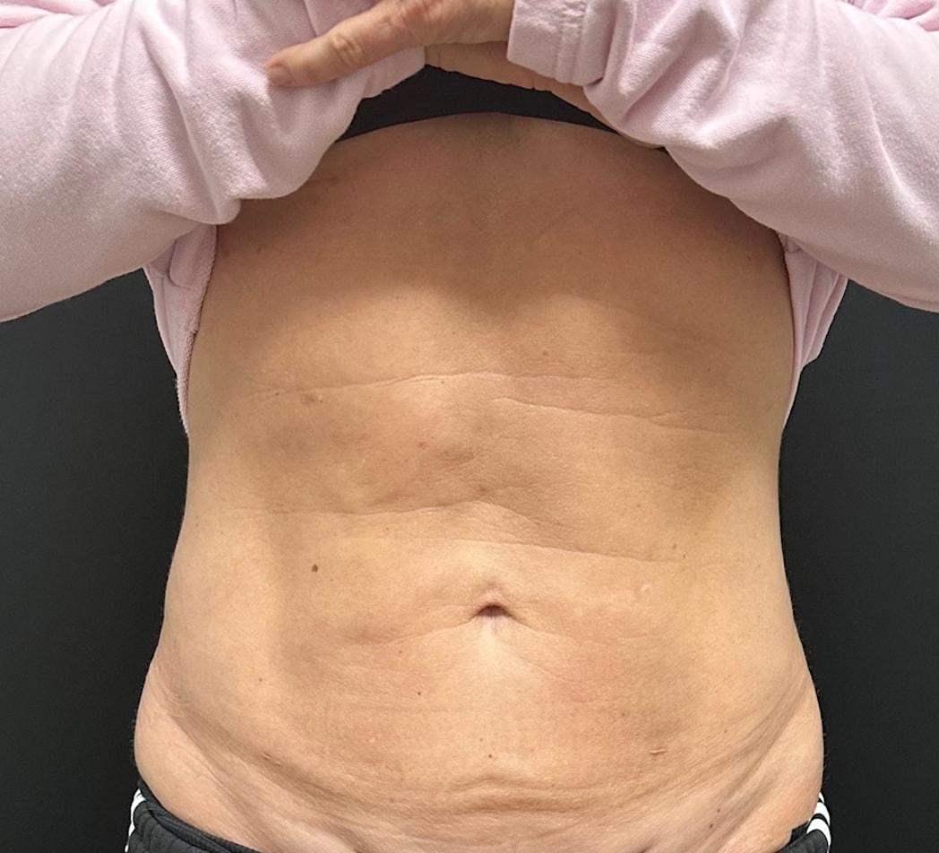 Norcal Liposculpture (Jack D. Friedlander, MD) liposuction after — Roseville, CA