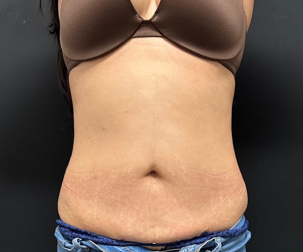 Norcal Liposculpture (Jack D. Friedlander, MD) liposuction after — Roseville, CA