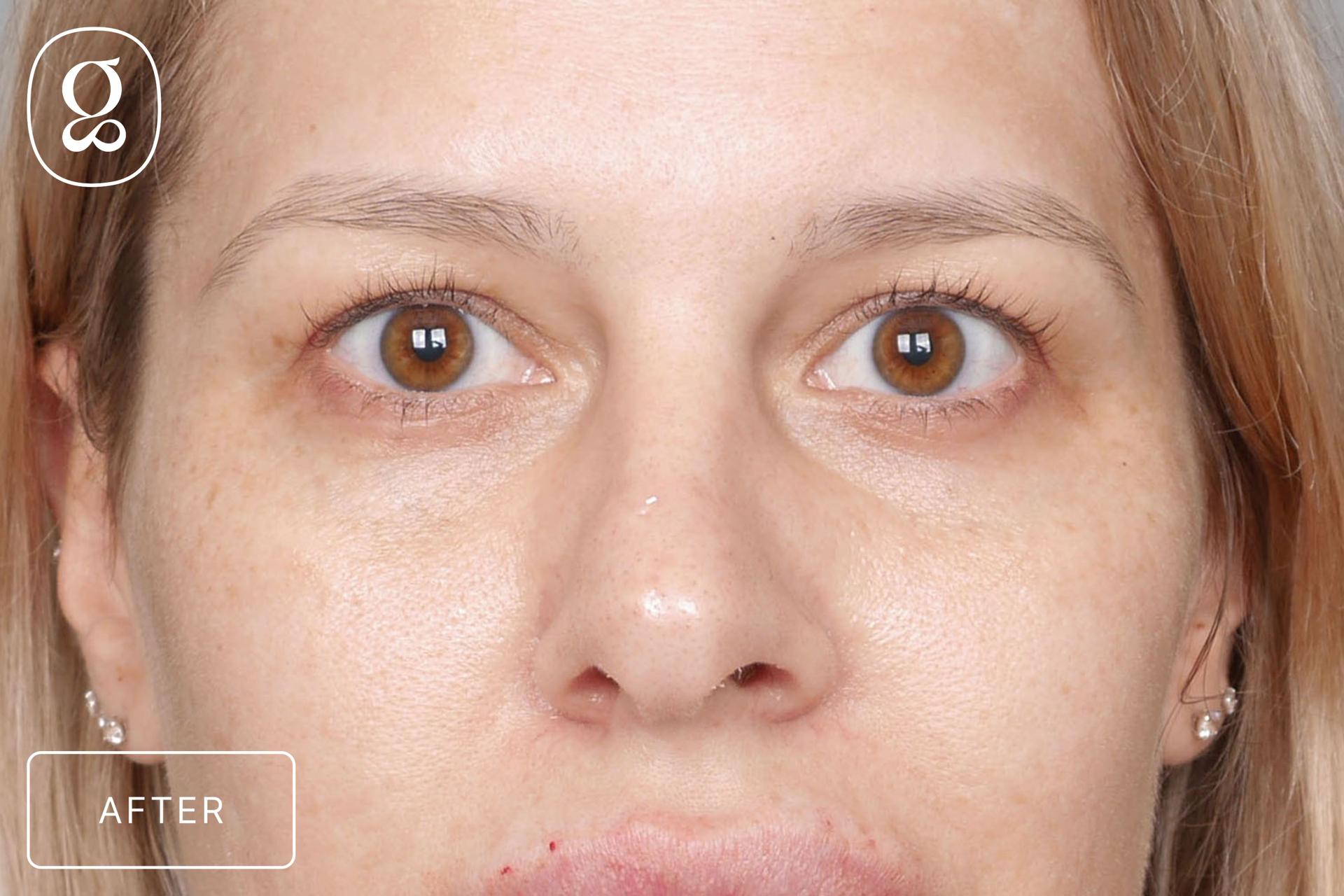 Gould Aesthetics eyelid lift after — Beverly Hills, CA