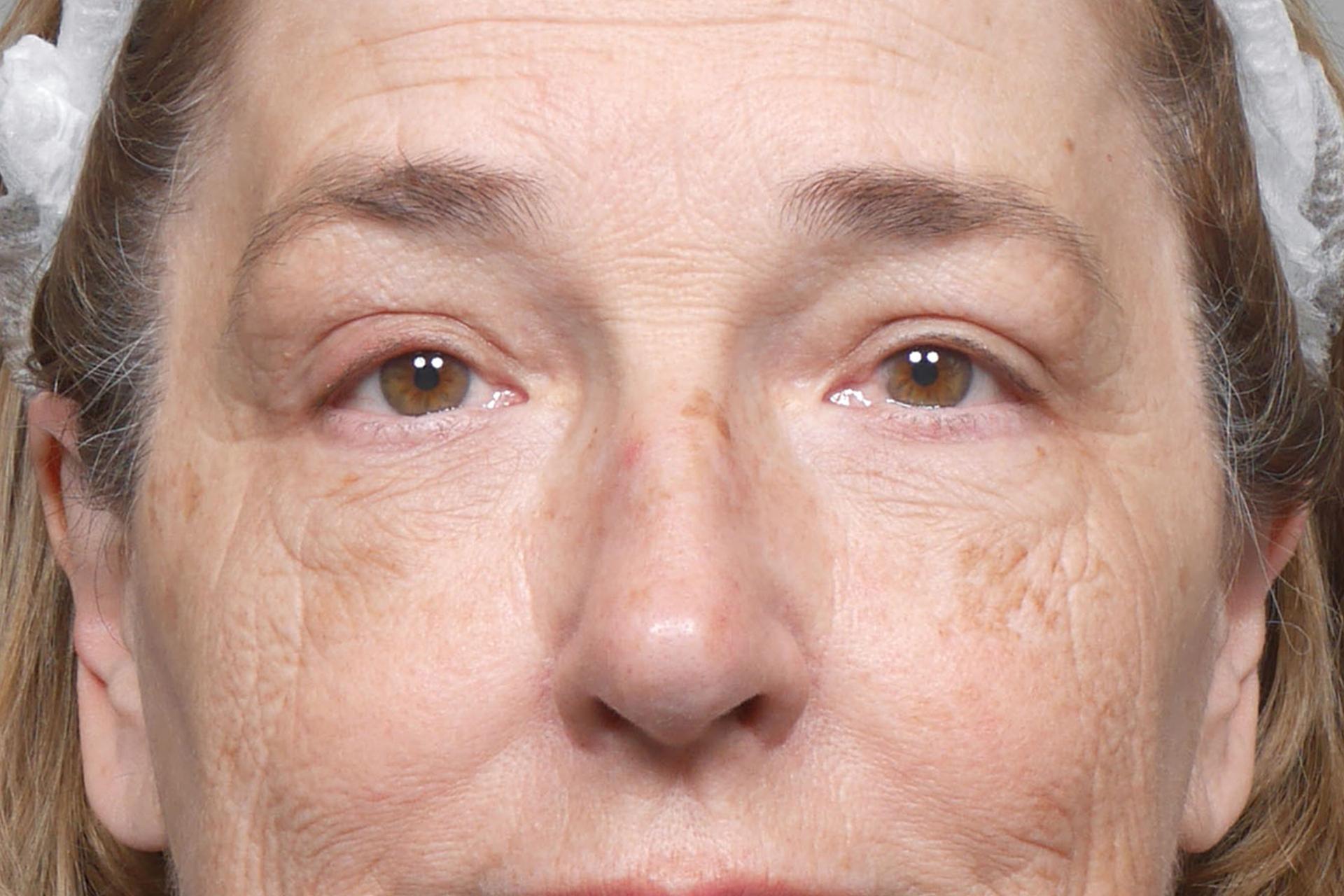 Gould Aesthetics eyelid lift after — Beverly Hills, CA